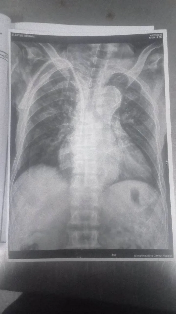 إجراء مجموعة من العمليات الجراحية المعقدة لمرضى الفشل الكلوي المزمن في المحمودية إجراء مجموعة من العمليات الجراحية المعقدة لمرضى الفشل الكلوي المزمن في المحمودية