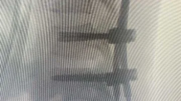 نجاح طبي: علاج كسر في فقرات الظهر لمريض عبر الجلد في مستشفى بنها الجامعي (تفاصيل)