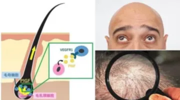 عاجل.. باحثون يجدون حلاً سهلاً لمشكلة تساقط الشعر