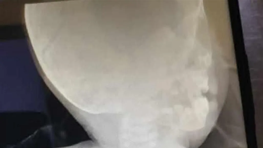نينوى.. إنقاذ طفل بعد ابتلاعه حبة زيتون