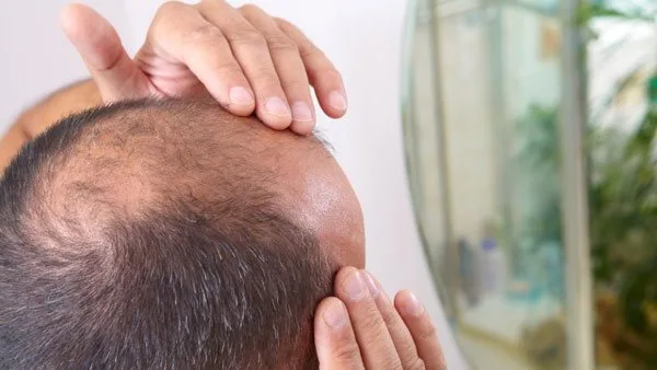 تنبيه للرجال: علاج معروف لتساقط الشعر يمكن أن يؤثر سلبًا على الحياة الجنسية تنبيه للرجال: علاج معروف لتساقط الشعر يمكن أن يؤثر سلبًا على الحياة الجنسية
