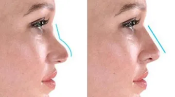 تقنيات تجميل الأنف بدون جراحة: الفيلر والخيوط في ميزان الجمال والفعالية
