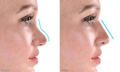 تقنيات تجميل الأنف بدون جراحة: الفيلر والخيوط في ميزان الجمال والفعالية تقنيات تجميل الأنف بدون جراحة: الفيلر والخيوط في ميزان الجمال والفعالية