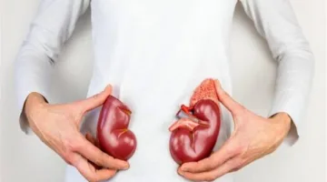 أكثر الأفراد عرضة للإصابة بالنقرس