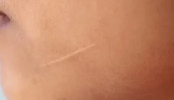 شرائح السيليكون لإزالة الندوب: الطريقة العصرية لاستعادة إشراقة بشرتك