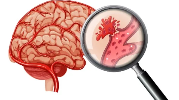 جهاز طبي حديث.. ابتكار جديد لعلاج السكتات الدماغية | معلومات إضافية جهاز طبي حديث.. ابتكار جديد لعلاج السكتات الدماغية | معلومات إضافية