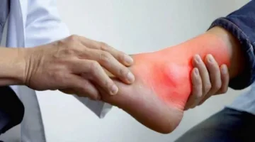 الماء يخفف الأضرار: نصائح لحماية مرضى النقرس من مخاطر تناول لحوم العيد