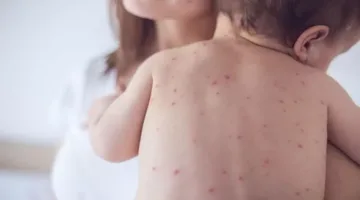 تراجع انتشار الحصبة في الولايات المتحدة.. وميشيغان وبنسلفانيا تعلنان رسميًا خلوهما من المرض