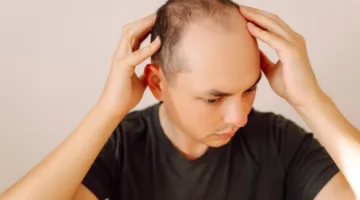 جين يتيح فرصاً جديدة لمعالجة مشكلة الصلع