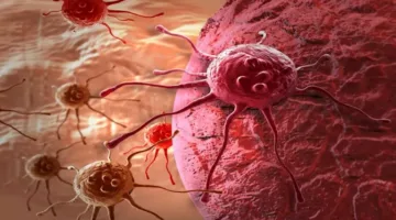 سرطان الزائدة الدودية: 5 أعراض مبكرة قد تمر unnoticed