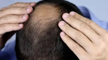 علاج مبتكر يمكن أن يضع حداً للصلع.. هل نحن على أبواب إنهاء تساقط الشعر؟