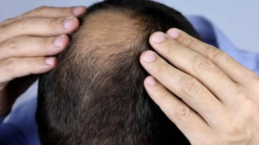 علاج مبتكر يمكن أن يضع حداً للصلع.. هل نحن على أبواب إنهاء تساقط الشعر؟ علاج مبتكر يمكن أن يضع حداً للصلع.. هل نحن على أبواب إنهاء تساقط الشعر؟